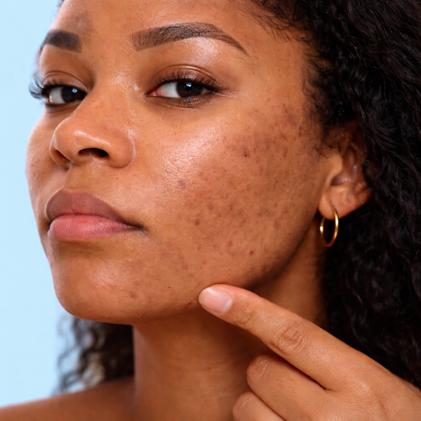 What You Need to Know: About Hydro Microdermabrasion for Sensitive & Melanin-Rich Skin