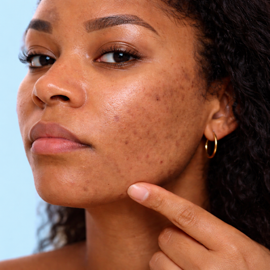 What You Need to Know: About Hydro Microdermabrasion for Sensitive & Melanin-Rich Skin